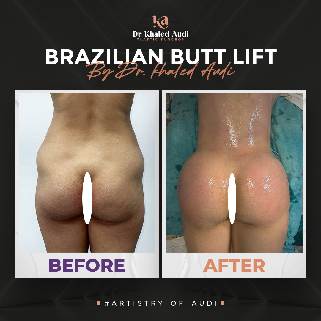 شد-المؤخرة-البرازيلية